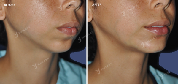 Chin Implant 2[1].png (600×283)